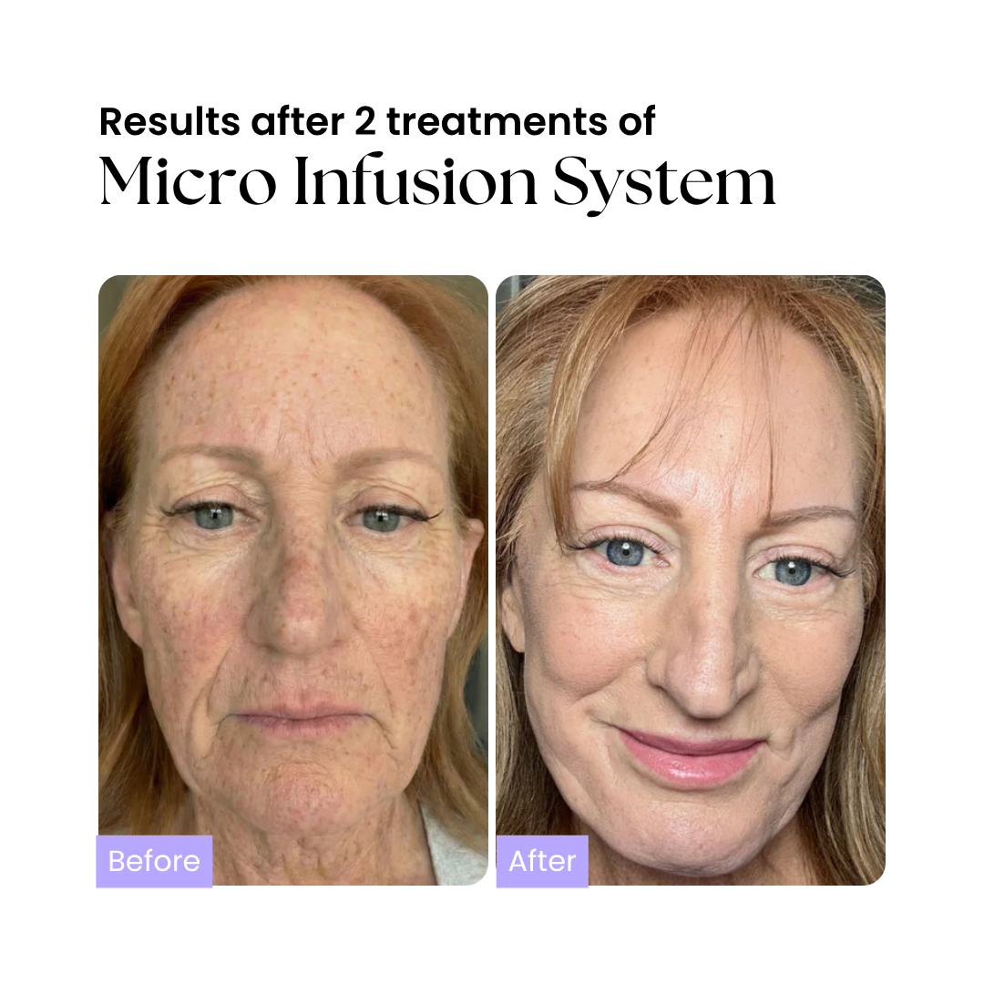 Glow Micro-Infusion System