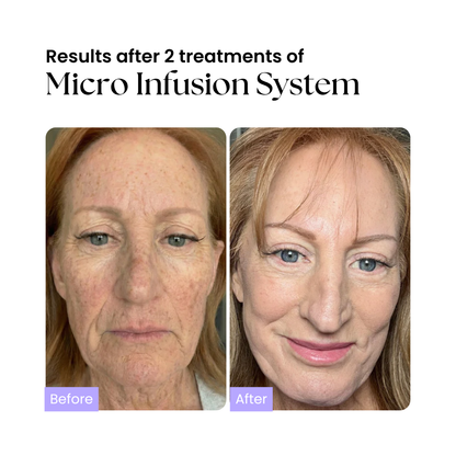 Glow Micro-Infusion System