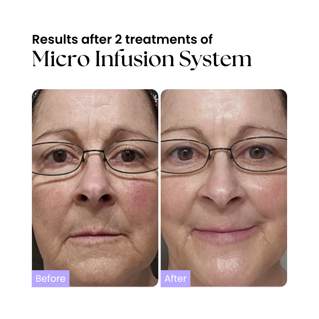 Glow Micro-Infusion System